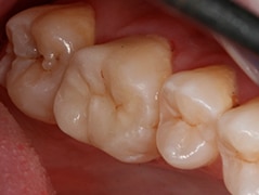 Onlay emax